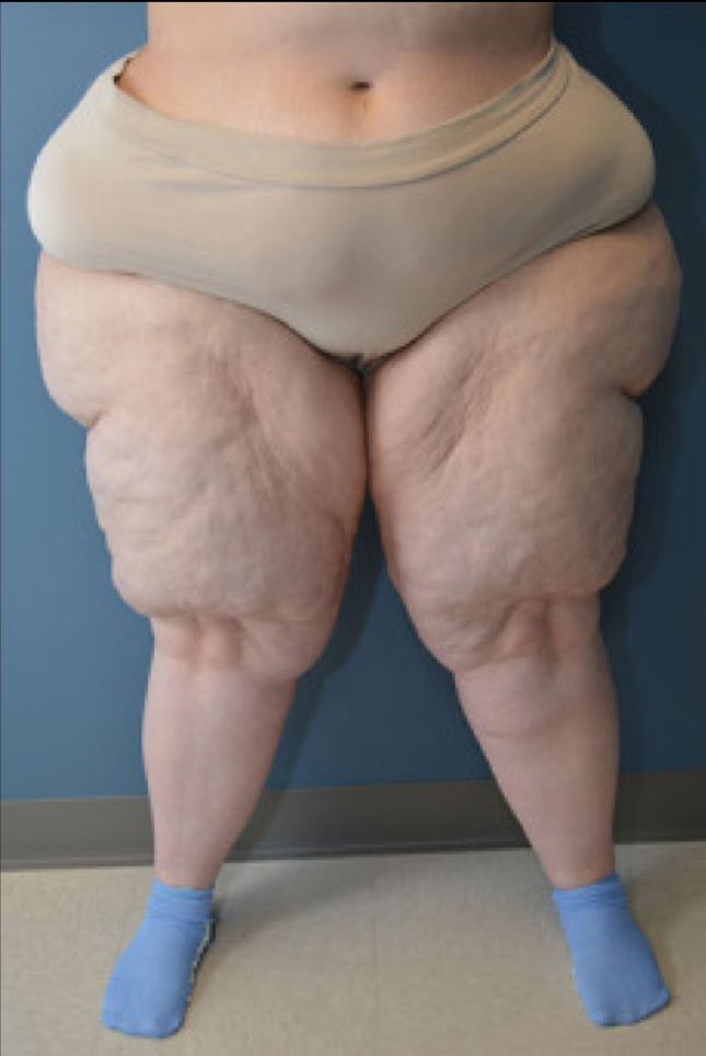 Trattamento non invasivo del lipedema